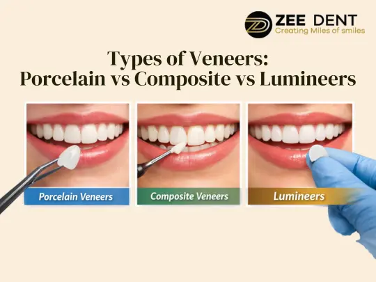 Types of Veneers Porcelain vs Composite vs Lumineers