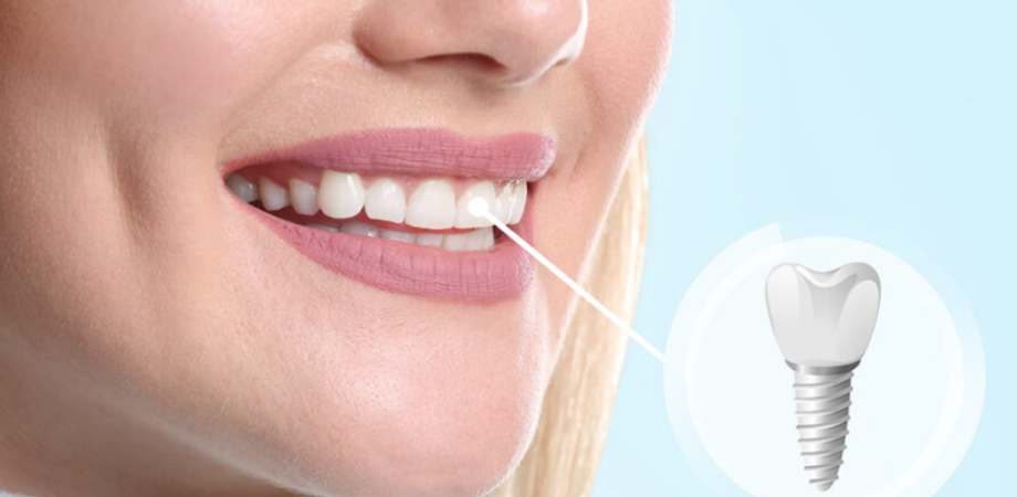All on 4 Dental Implants in Dubai for Full Mouth Restoration