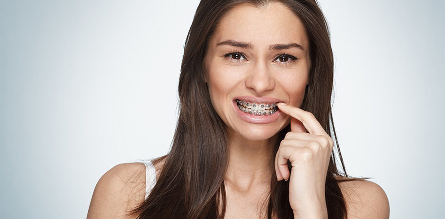 Dental Braces - How to care