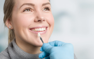 The Benefits of Dental Veneers
