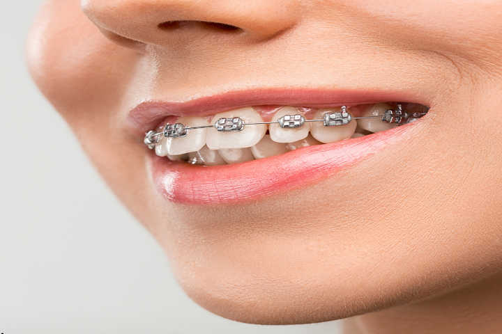Orthodontics Treatment