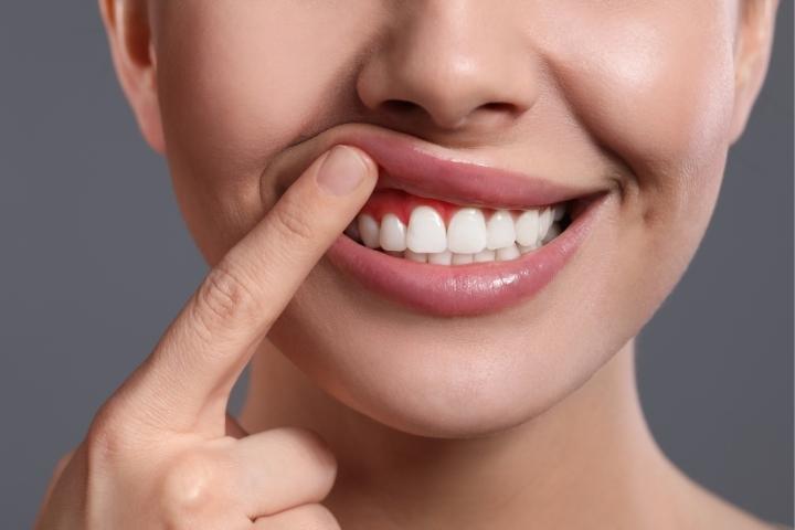 Aesthetic Gum Treatment Dubai