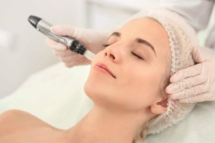 Dermapen microneedling treatment improving skin texture