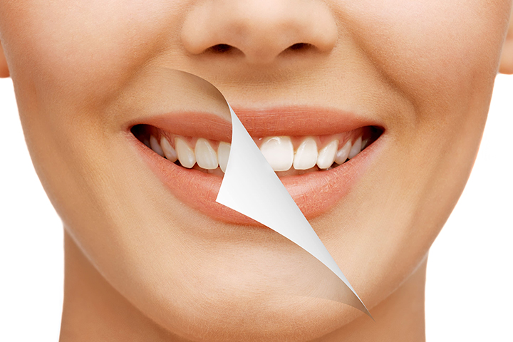 Smile Makeover in Dubai