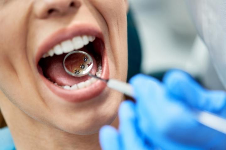 invisible-lingual-braces