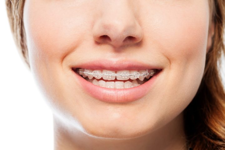 Orthodontic Treatments in Dubai