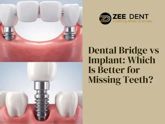 Dental Bridge vs Implant Which Is Better for Missing Teeth