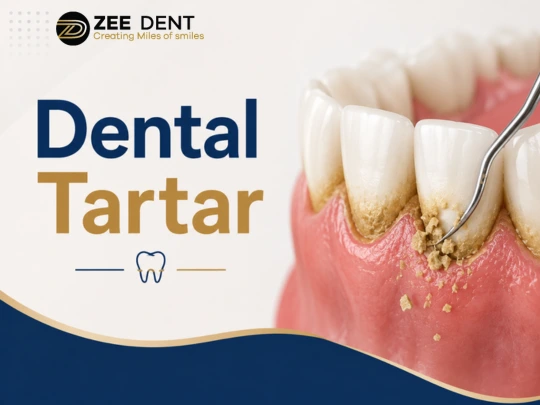 Dental Tartar Causes, Signs, Removal Methods and How to Prevent It