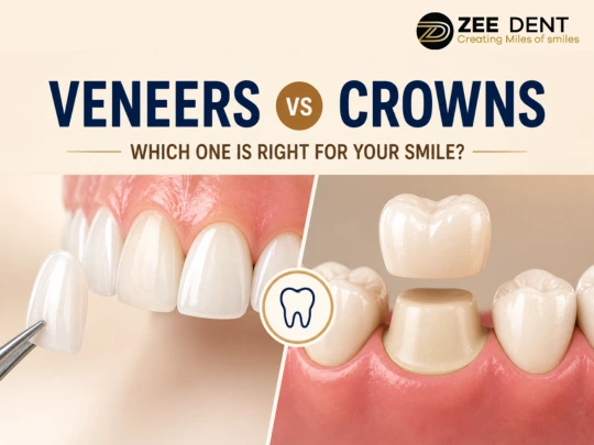 Veneers vs Crowns Differences