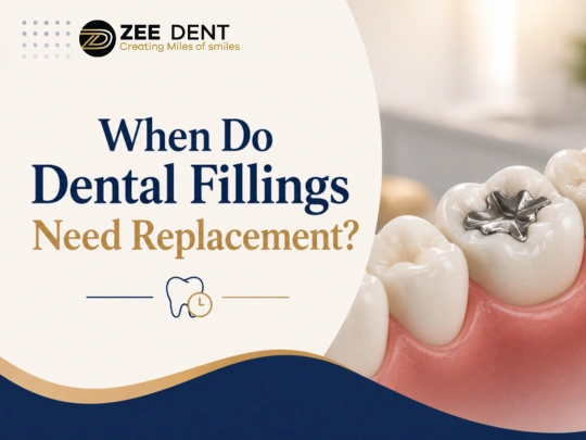 How Often Do Dental Fillings Need to Be Replaced